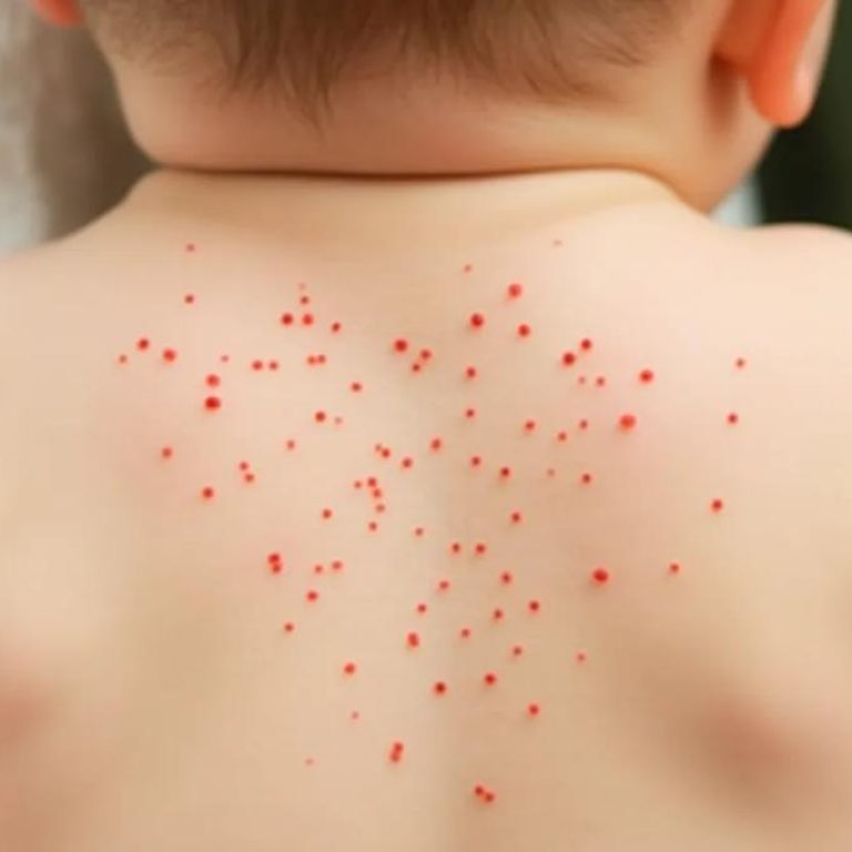 Baby-rash-908ab262d30b4233a182501225957bec